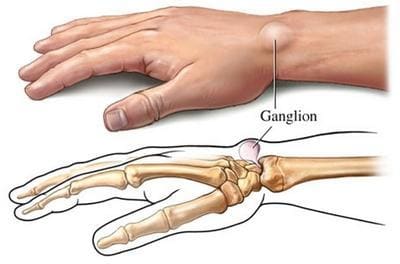 ganglion